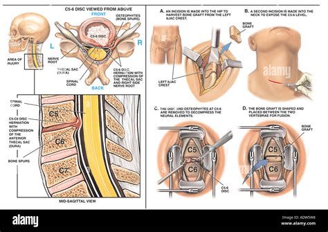 Anterior Cervical Discectomy And Arthrodisc Replacement Order Ph
