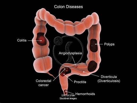 medical illustration showing types of colon diseases stocktrek images