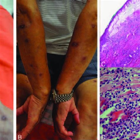 Pyoderma Gangrenosum A And B Multiple Painful And Tender Shallow