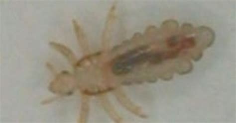 Head Lice Pictures: Home Remedies for Head Lice