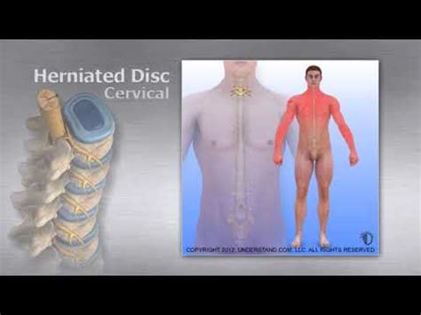 What Is Cervical Disc Herniation How Is It Treated My Xxx Hot Girl