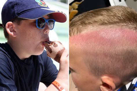 Boy 8 Came Home From School With Severely Sunburnt Head And Sparks