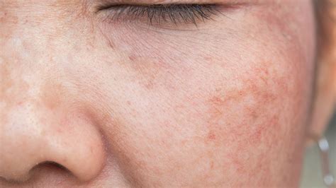Can You Repair Sun Damaged Skin Sharp Healthcare