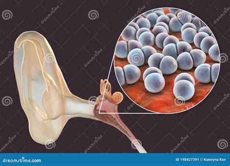 Otitis Media Inflammatory Disease Of The Middle Ear Stock Illustration