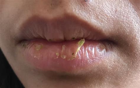 Why Wont My Lips Stop Peeling Puchong Ian 蒲种人