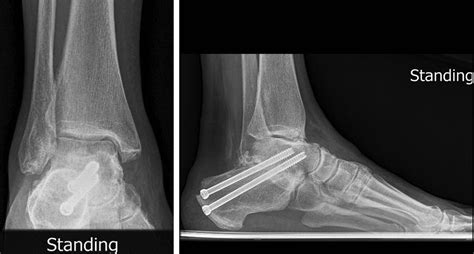 Taking Out The Tarsal Coalition Was Easy Foot And Ankle Clinics