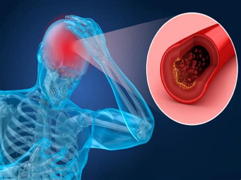Hemorrhagic Stroke Symptoms Causes Diagnosis And Treatment