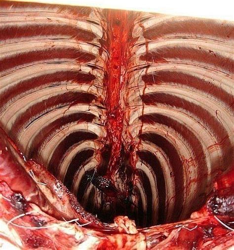 But the ribcage protects most of your vital organs along with layers and layers of muscle tendon or tissue. 17 Best images about Surgical Technologist on Pinterest ...