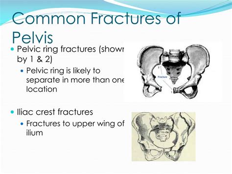 Ppt Pelvic Immobilization Devices Powerpoint Presentation Free