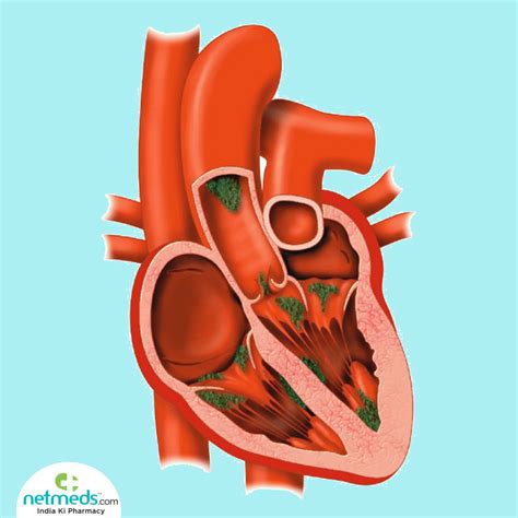 Endocarditis Causes Symptoms And Treatment