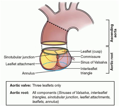 Ascending Aortic Aneurysms Thoracic Key