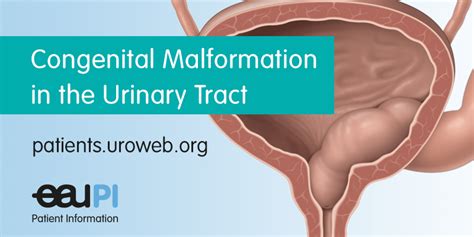 Duplex Congenital Malformations Of The Urinary Tract Patient Information