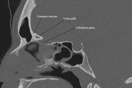 Olfactory fossa | Image | Radiopaedia.org