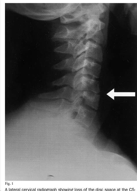Figure 1 From Phantom Limb Pain Due To Cervical Spinal Tuberculosis A