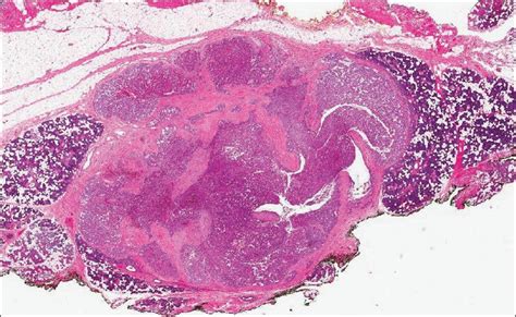 Histologically The Tumor Is A Circumscribed Unencapsulated Lobulated
