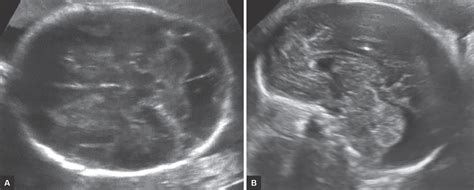 Dandy Walker Malformation Ultrasound