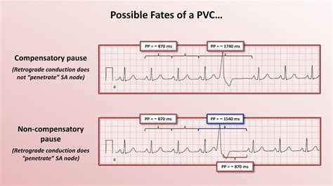 What Premature Ventricular Contraction Pvc Looks Like On 54 Off