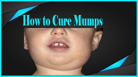 Mumps What Is Mumps Mumps Symptoms Mumps Treatment Mumps In