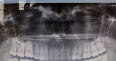 Partially Erupted Wisdom Tooth That Grew In Direction Perpendicular To