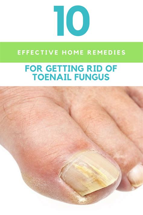 10 Effective Home Remedies For Getting Rid Of Toenail Fungus Toenail