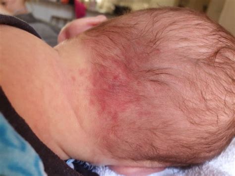 Rash On Base Of Neck Babycenter