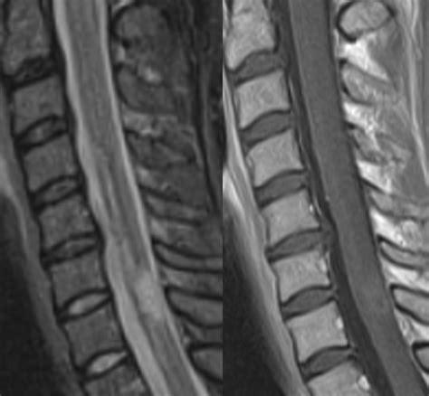 Multiple sclerosis (ms) is the most common inflammatory demyelinating disease of the central nervous system in tumefactive ms is a variant of multiple sclerosis. Multiple sclerosis (cervical spinal cord) — Clinical MRI