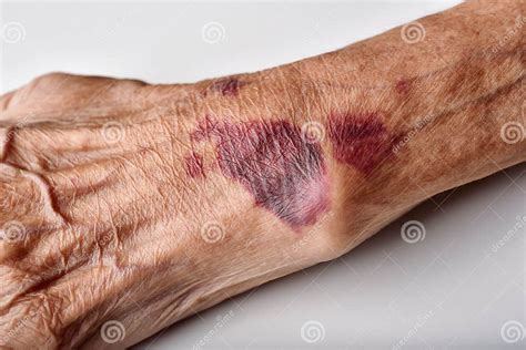 Bruise Wound On Senior People Wrist Arm Skin Falls Injury Accident