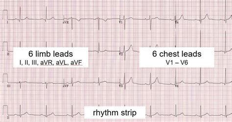 The Layout Of The 12 Lead Ecg The Rhythm Strip Is A