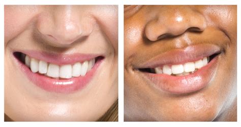 Get The Smile You’ve Always Wanted Marylebone Implant Centre