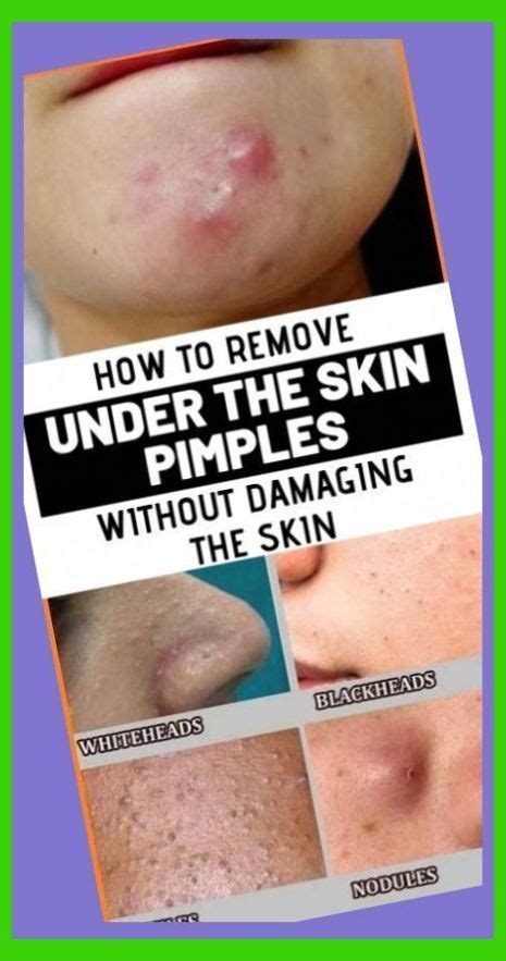 How To Get Rid Of Blind Pimples Naturally Blind Pimple On Nose How