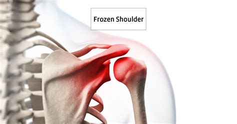 Frozen Shoulder Symptome Ursache Diagnose Behandlung Und Mehr