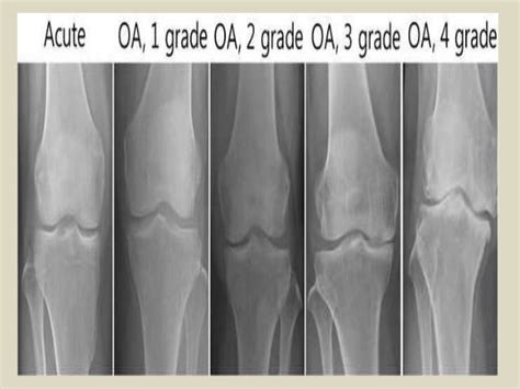 Osteoarthritis Knee Mri