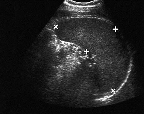 Sonographic Evaluation Of Spleen Size In Tall Healthy Athletes Ajr