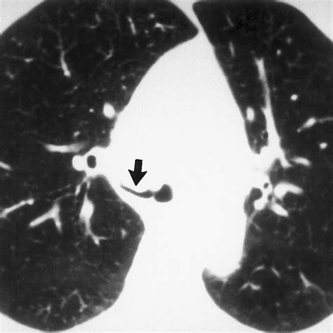 Abdominal Tuberculous Lymphadenitis Axial Contrast Enhanced Ct Scan
