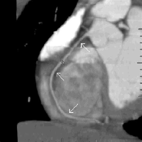 Angiografía Coronaria Mediante Tomografía Computarizada Multicorte