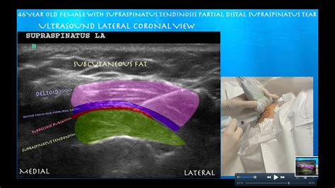 Ultrasound Of Supraspinatus Tendinosis Partial Distal Articular Sided