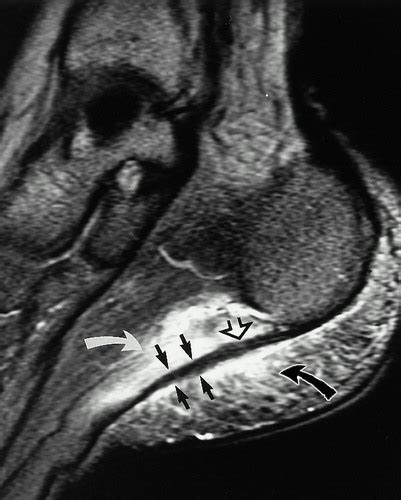 First lumbrical, abductor hallucis, flexor digitorum the plantar fascia which surrounds all muscles of the sole of the foot consists of three chambers. Plantar Fasciitis and Fascial Rupture: MR Imaging Findings ...