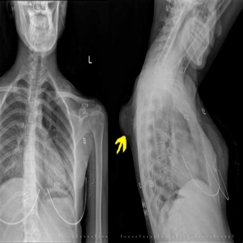 Scapula Bone Anatomy Ct Scapula Anatomy Diagrams Radiology Case