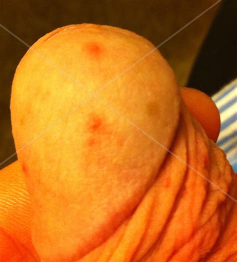 Small Red Dots On Penis Does It Look Like Herpes Imgur