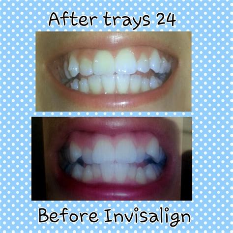 Reader favorites from curly crafty mom My Invisalign (Teen) Journey