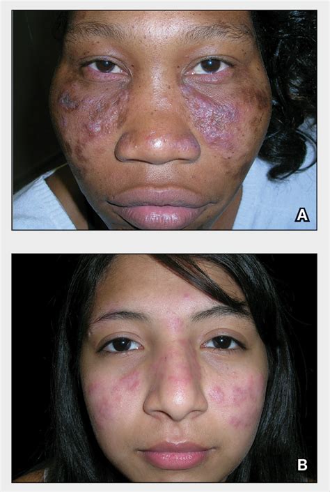 Discoid Lupus Mdedge Dermatology