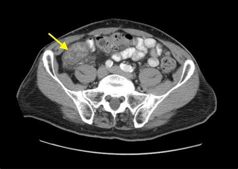 Imaging Findings Of Small Bowel Diverticulitis A Case Report Jetem