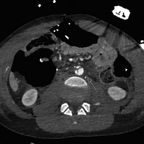 Abdominal Ct Scan After Laparotomy Showing A Short Intimal Laceration