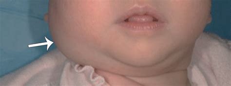 Submandibular Gland Swelling In Children