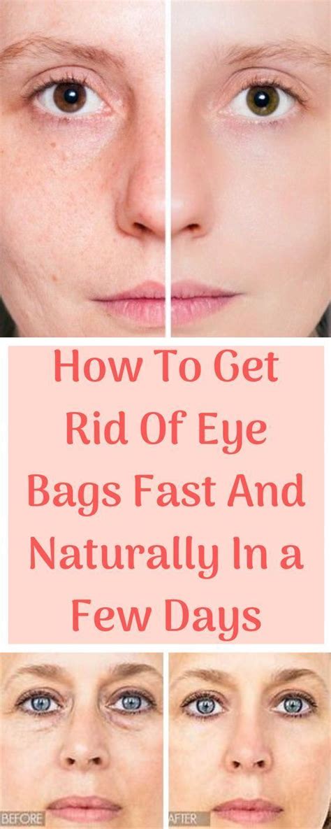 How To Get Rid Of Eye Bags Fast And Naturally In A Few Days Eye Bags Remove Eye Bags Skin