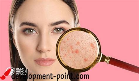Causes And Treatment Of Pimples Under The Skin Development Point