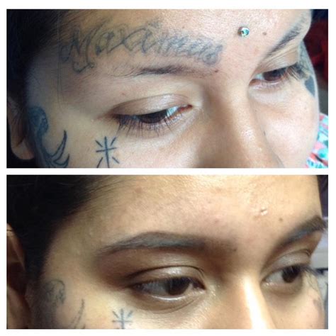 Tattoo Removal Before And After How To Get Rid Of Tattoo 2019