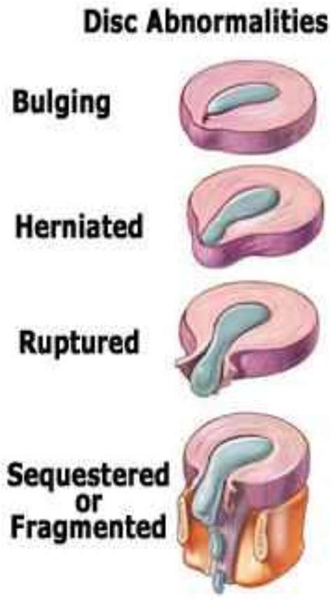Bulging Disc Vs Herniated Disc Whats The Difference