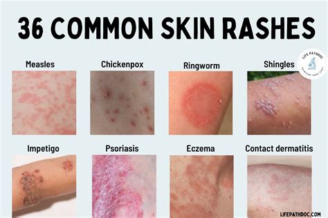 Skin Rashes Images