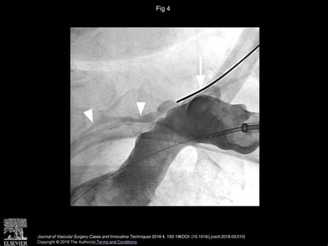 Chylothorax Secondary To Venous Outflow Obstruction Treated With